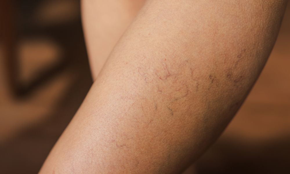 Début de varices