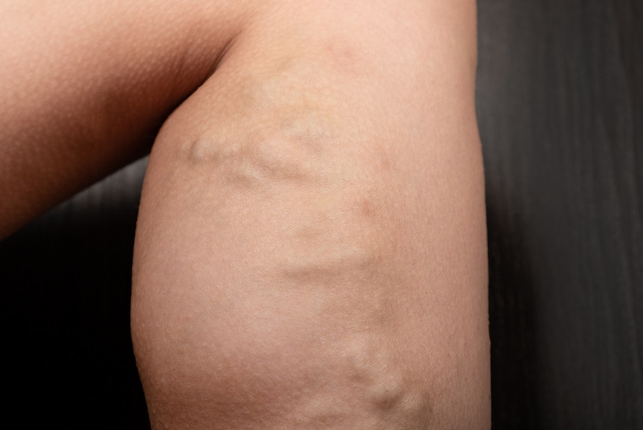 Le danger des varices : risques, complications et traitements