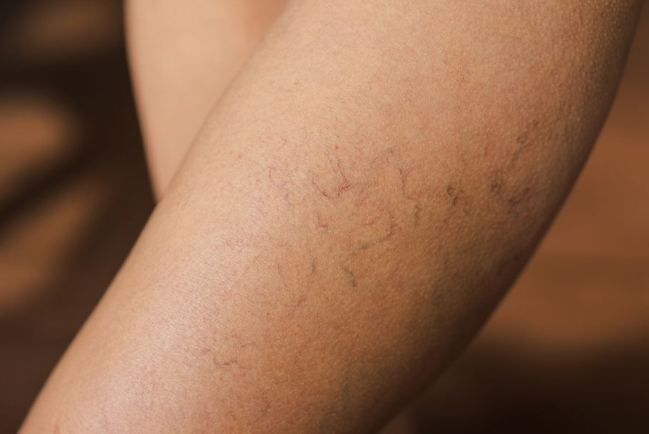 Début de varices : les premiers signes à reconnaître et comment réagir