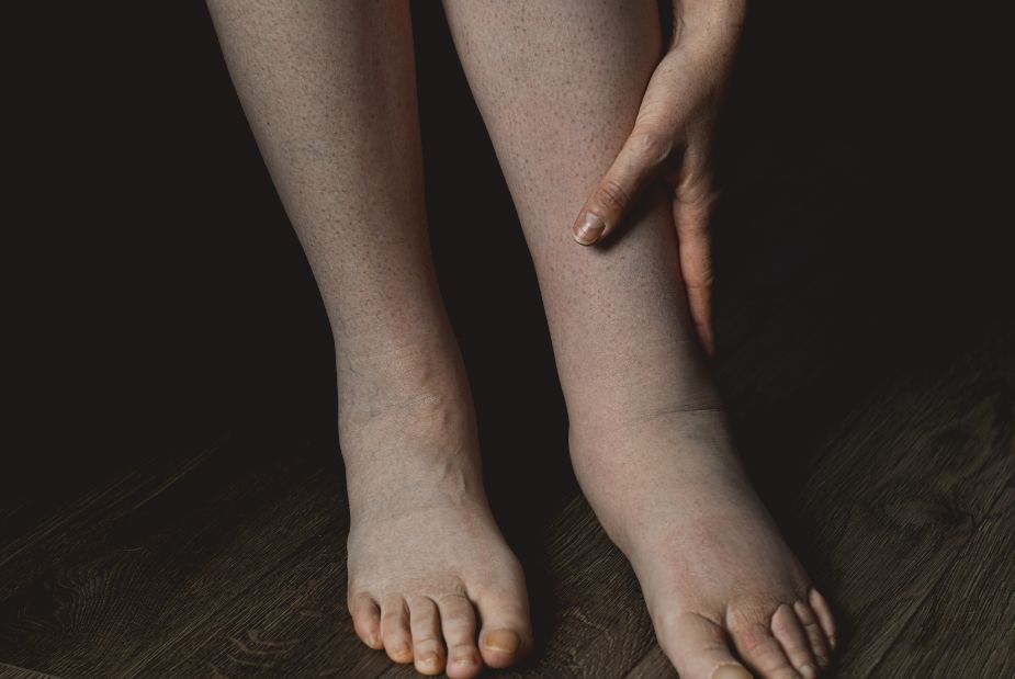 Lymphoedème des jambes : et si on pouvait aller mieux ?