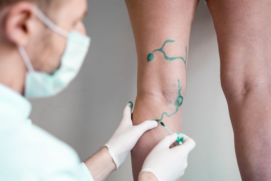 Varices aux jambes : définition, symptômes, causes et traitements