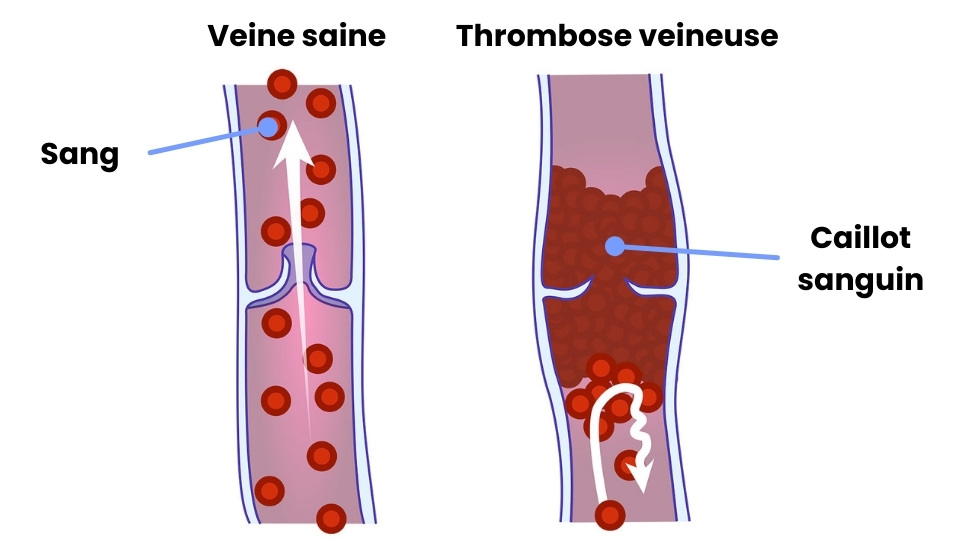 bas-contention-apres-operation-thrombose-veineuse.jpg