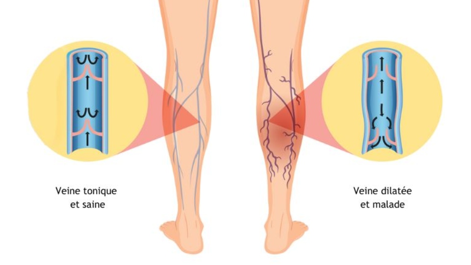 Schéma varices