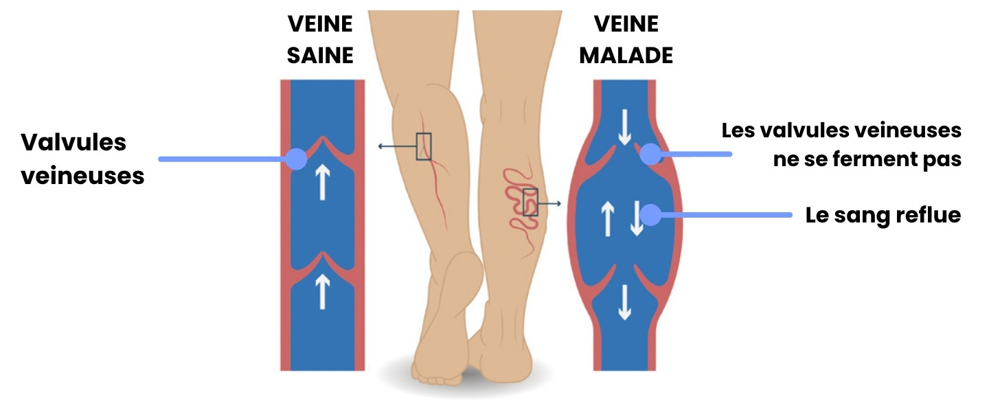 Schéma comparatif veines saines et veines malades avec le fonctionnement de la circulation sanguine et du retour veineux