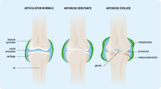 Genouillère-attelle pour le traitement de la gonarthrose (arthrose du genou  fémoro-tabiale) goural 215440 : Distributeur national EXCLUSIF d'orthèses  auprès des particuliers et professionnels