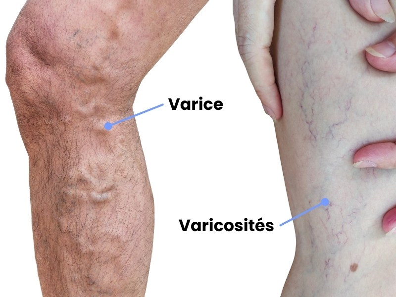 sauna-varices-varicosites.jpg