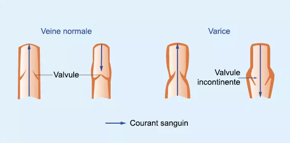 Valvules varices aux jambes